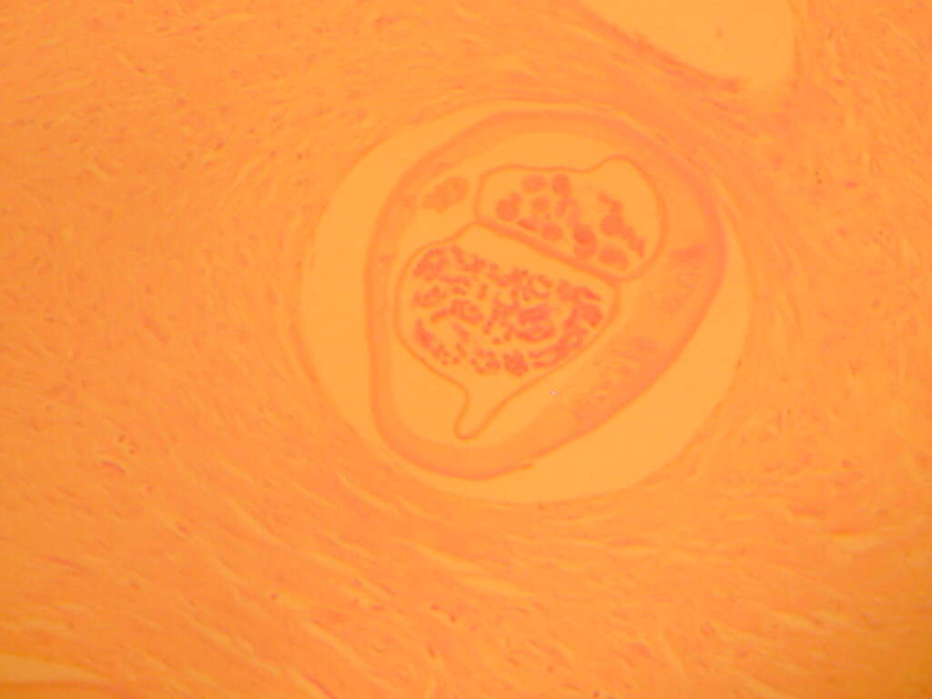 Image of <i>Onchocerca volvulus</i>