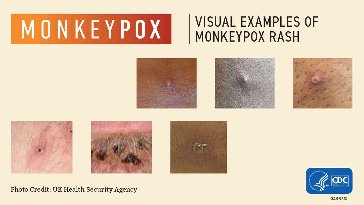 Image of Monkeypox virus