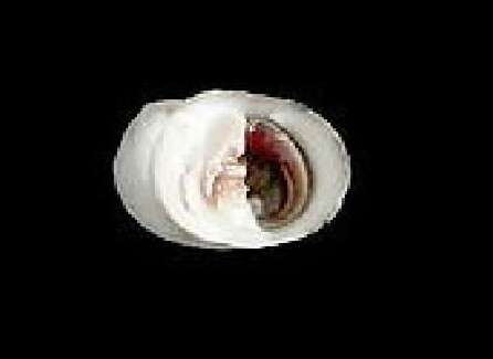 Image of bleeding tooth