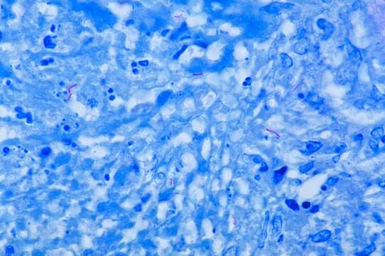 Imagem de 'Mycobacterium tuberculosis complex'