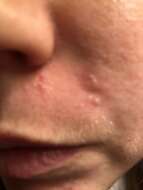 Sivun Cutibacterium acnes kuva