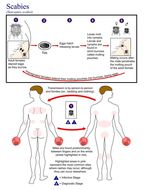 Image of <i>Sarcoptes scabei</i>