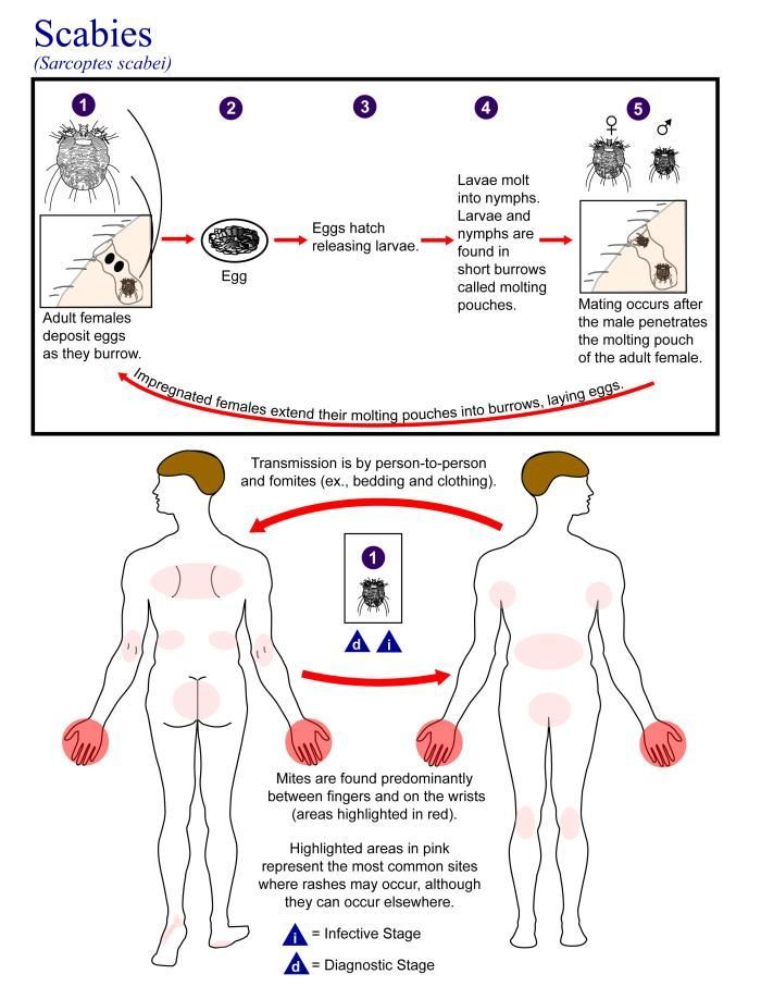 Image of <i>Sarcoptes scabei</i>