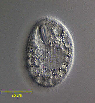 Image of Glaucoma scintillans