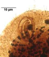 Image of Glaucoma scintillans