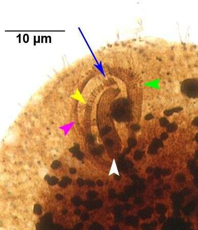 Image of Glaucoma scintillans