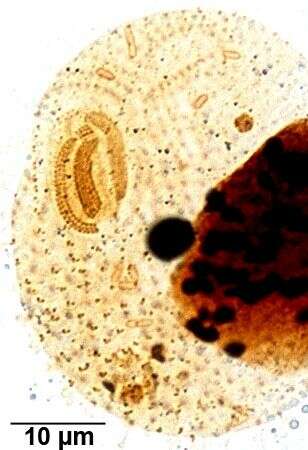 Imagem de Glaucoma scintillans