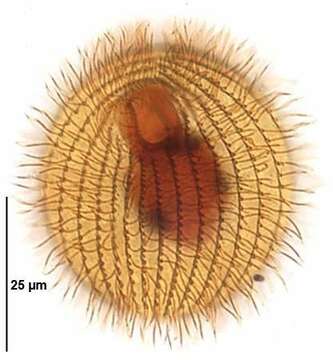 Imagem de Glaucoma scintillans