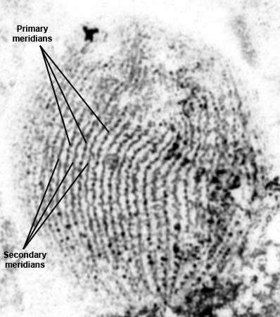 Image of Glaucoma scintillans