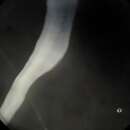 Image of Carinoma