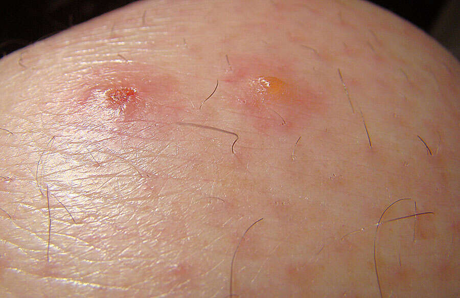 Image of chiggers