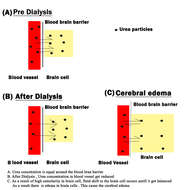 Image of Dialysis