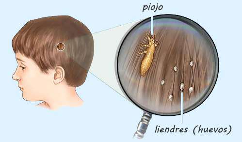 Image of lice