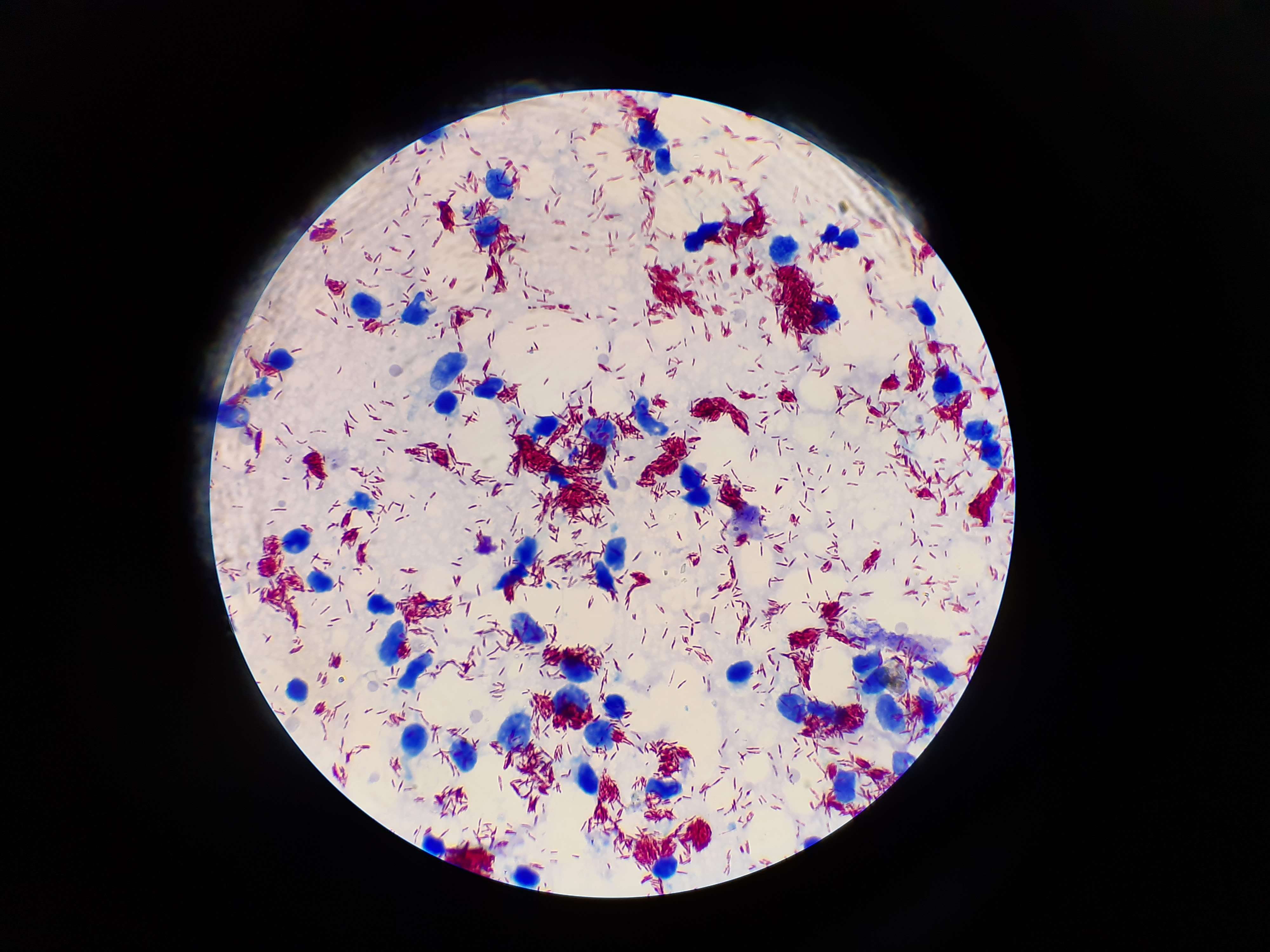 Image of Hansen’s coccus spirilly